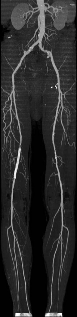 BEINANGIOGRAPHIE